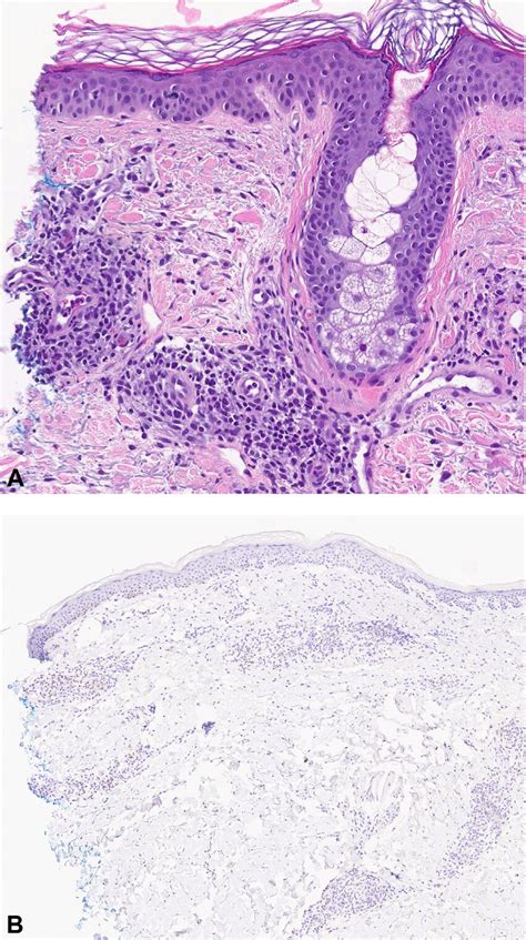 Skin Pathology Findings A A Perivascular Lymphoid Infiltrate Composed
