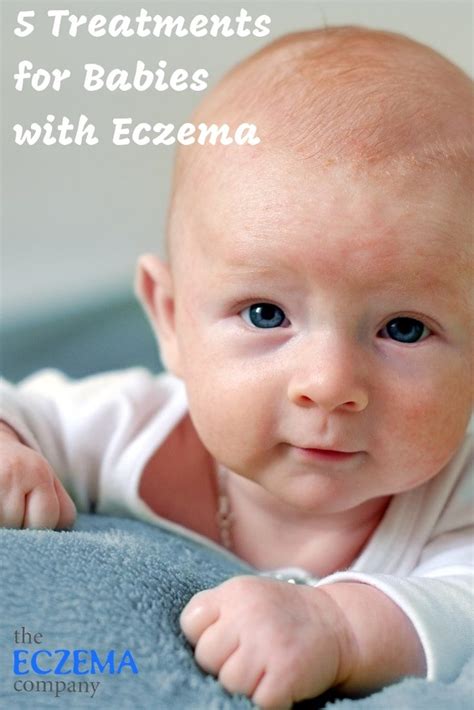 5 Treatments For Babies With Eczema En 2020 Avec Images Bebe