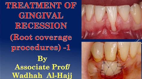 Periodontal Surgery Treatment Of Gingival Recessionintroduction