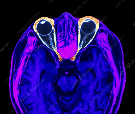 Eyes Optic Nerves And Brain Mri Scan Stock Image P3320420