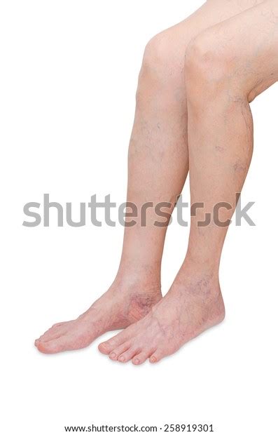 Woman Legs Varicose Veins On White Stock Photo Edit Now 258919301