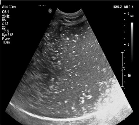 Abdominal Ultrasound Showed Severely Dilated Stomach Download