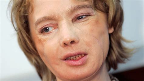 Woman Who Received Worlds 1st Face Transplant Dies At 49