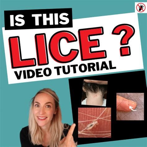 What Lice Look Like Video Tutorial My Lice Advice