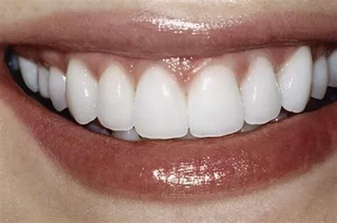 Lowenberg Lituchy Kantor Patient Porcelain Veneers Straighten Teeth