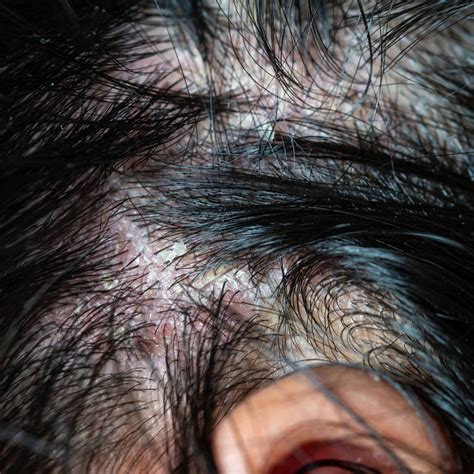 Things To Know And Do About Scalp Psoriasis Forces Of Nature Medicine