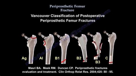 Periprosthetic Fracture Classification