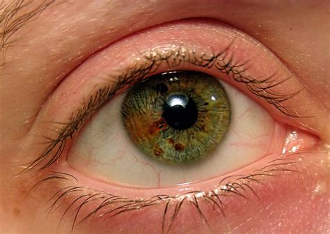 Sectoral Heterochromia Different Types Of Eyes Heterochromia