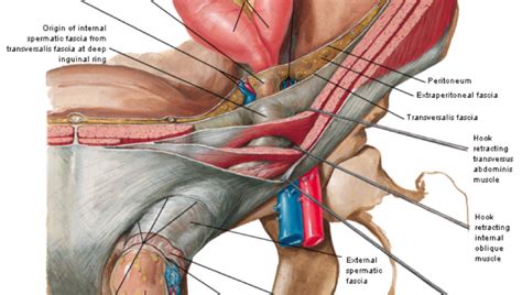 Often groin strain occurs in the area of inguinal ligament. inguinal ligament ct - ModernHeal.com