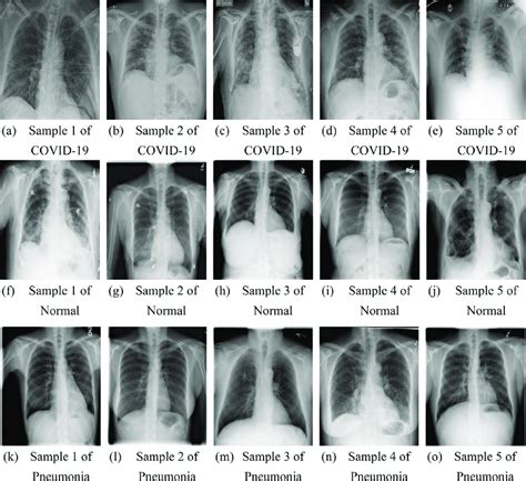 Samples Of Chest X Ray Images Dataset Download Scientific Diagram