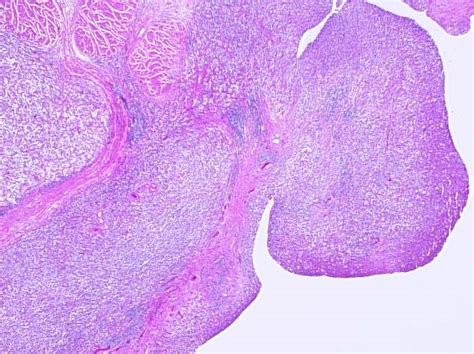 Pathology Outlines - Invasive urothelial carcinoma