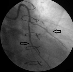 A number of significant variations in anatomy have been observed in the right coronary artery and its branches. Significant Restenosis of Multiple Saphenous Vein Grafts Early After Coronary Artery Bypass ...