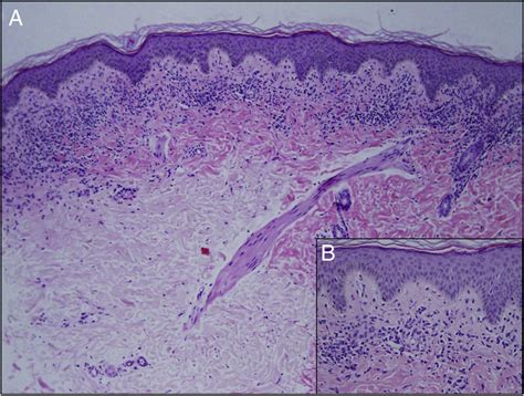 Histology Of The Lesion A A Band Like Lichenoid Inflammatory