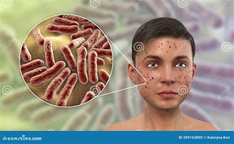 Acne Vulgaris And Bacteria Cutibacterium Acnes Stock Illustration