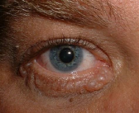 Different Types Of White Spots Under Eyelid And Home Remedies Treatment