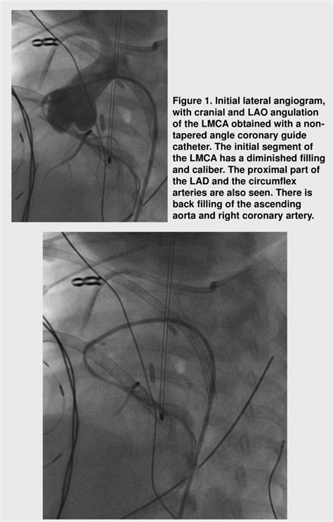 Lateral Angiogram Following Percutaneous Coronary Angioplasty With
