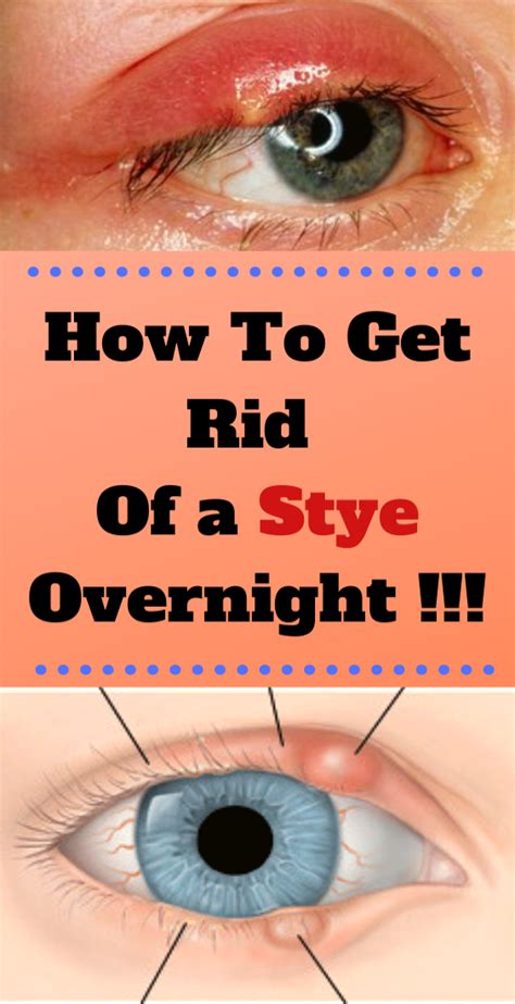 How To Get Rid Of A Stye Overnight Getting Rid Of A Stye Health