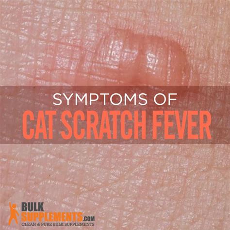Cat Scratch Fever Characteristics Causes And Treatment