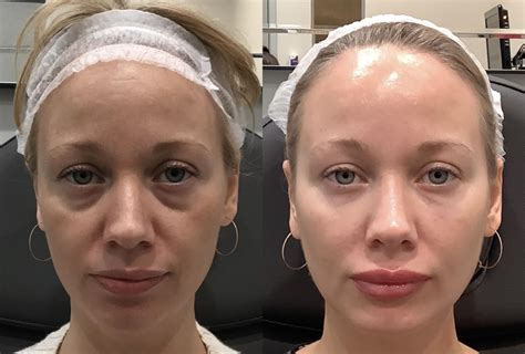 Dermal Fillers Before And After Pictures Case Sacramento Ca