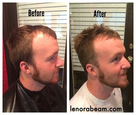 How To Fix Thinning Hair Male Naturally A Comprehensive Guide The