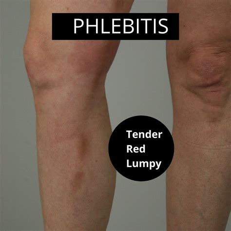 5 Essential Facts About Phlebitis The Veincare Centre