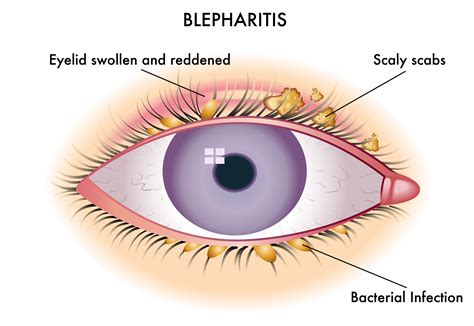 Blepharitis Icare Surgical Centre