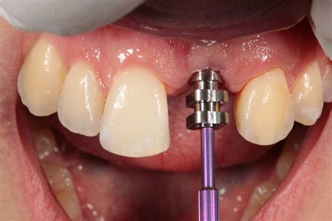 Implant Insights The Implant Impression Dentistry