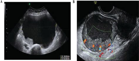 An imaging test of the ovaries, such as a transvaginal ultrasound exam, may be done. Ovarian Cancer and Pregnancy | IntechOpen