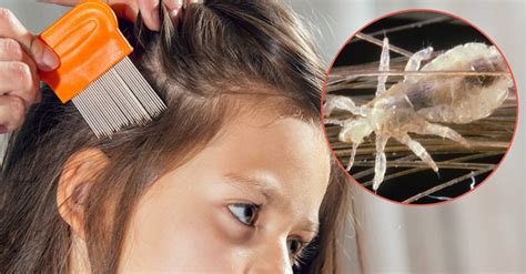 Moms Home Remedy For Head Lice — Have You Tried It