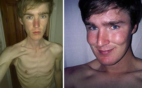 40 φωτογραφίες πριν και μετά ανθρώπων που νίκησαν την ανορεξία Fanpage