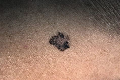 Early Melanoma Pictures 54 Photos And Images