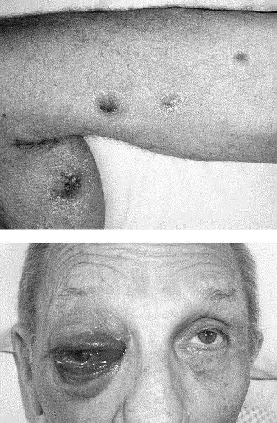 Orbital Cellulitis Panophthalmitis And Ecthyma Gangrenosum In An