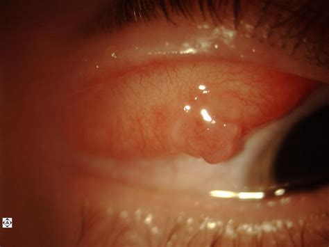 Granuloma Forming Around A Palpebral Conjunctival Foreign Body My XXX