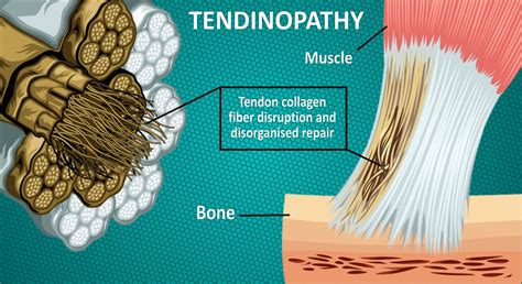 Tendinopathy Overuse Injury Collagen Fibers Photo And Video