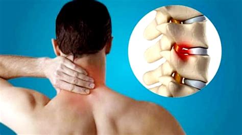 Cervical Spondylosis What Are Its Symptoms Treatment Arun Bhanot