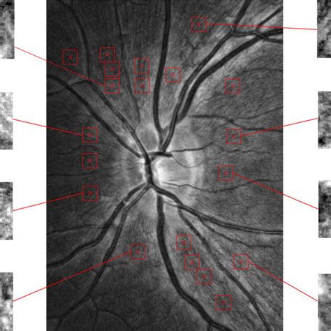 The Rgb Fundus Image Top With An Image Section Of The Gb Fundus Image