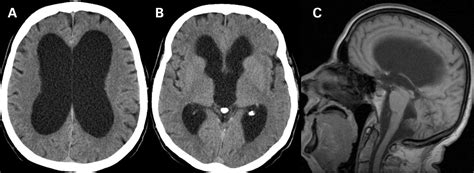 Memory Loss With Enlarged Brain Ventricles Bmj Case Reports