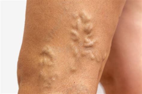 Varicose Veins On The Skin Macro Close Up Circulation Problem Medicine