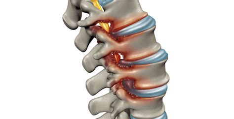 Cervical Stenosis What Is Cervical Stenosis