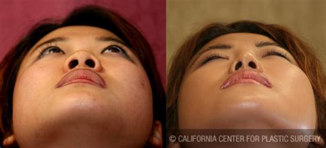 Patient Rhinoplasty Asian Before And After Photos Beverly Hills Plastic Surgery