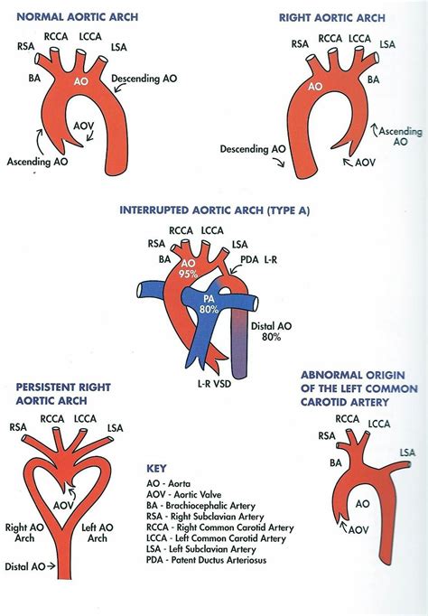 Right Sided Aortic Arch Nursing Study Medical Knowledge Cardiology