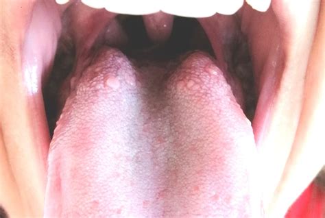Help Please I M Scare This Can Be HPV Oral And Dental Problems Forums Patient