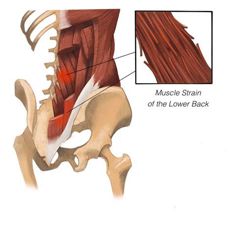 Muscles found in the deep group include the spinotransversales, erector spinae (composed of the iliocostalis, longissimus, and spinalis), the the muscles, bones, ligaments, and tendons in the back can all be injured and cause back pain. Spine Encyclopedia: Anatomy Of The Spine And Spine Ailments