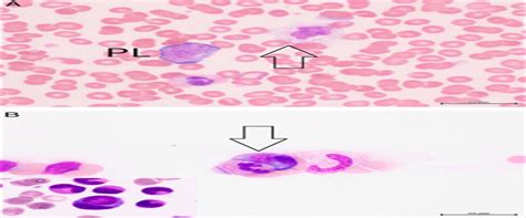 Peripheral Hemophagocytosis In Infectious Mononucleosis Red