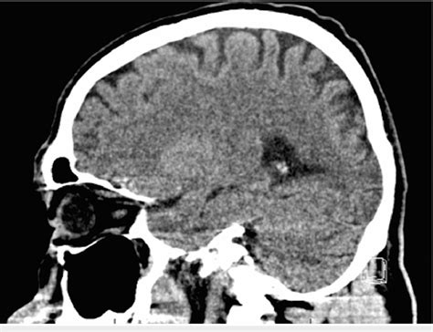 Normal Brain Ct Without Contrast Sagittal View Download Scientific