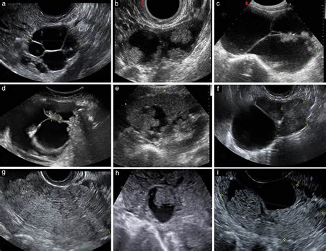 Serous Cystadenoma Ultrasound