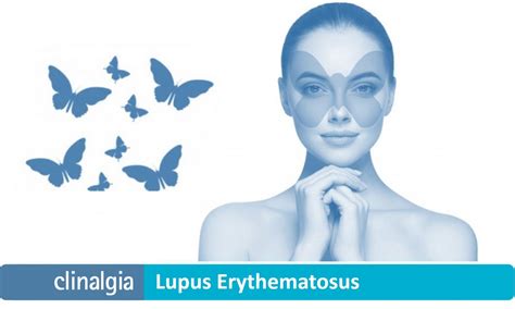 Lupus Erythematosus Symptoms And Treatment Symptoms And Treatment