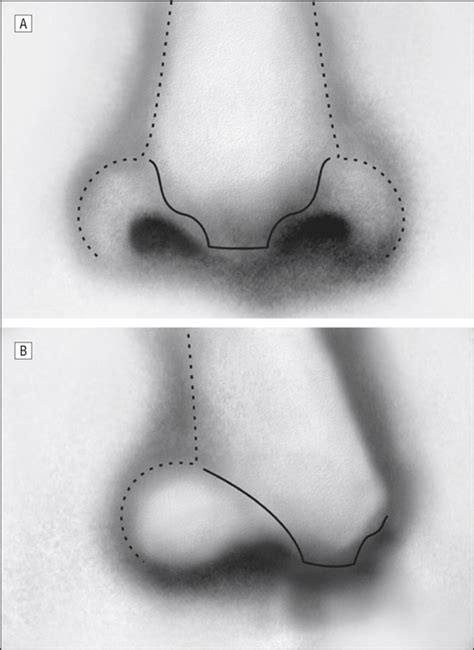 Hemangiomas Of The Nose Surgical Management Using A Modified Subunit