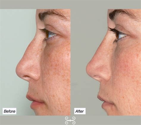 Non Surgical Nose Job Charleston Nose Reshaping Without Surgery Dr