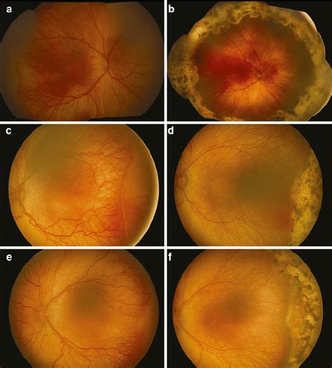 Before And After Laser Photocoagulation For Retinopathy Of Prematurity